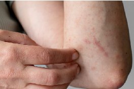 scar removal treatment cost in bangalore